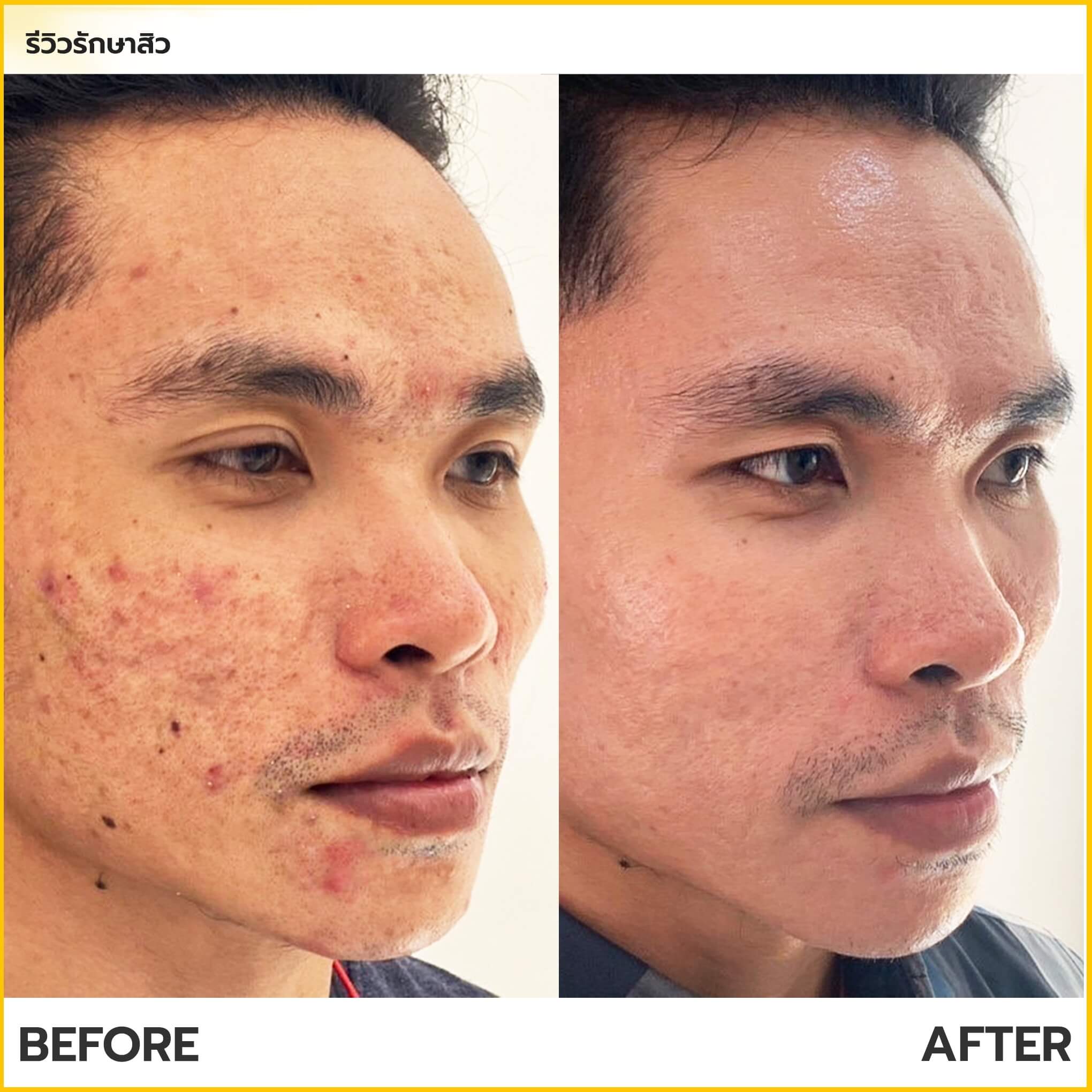 รีวิวรักษาสิว Jiin Clinic Thailand